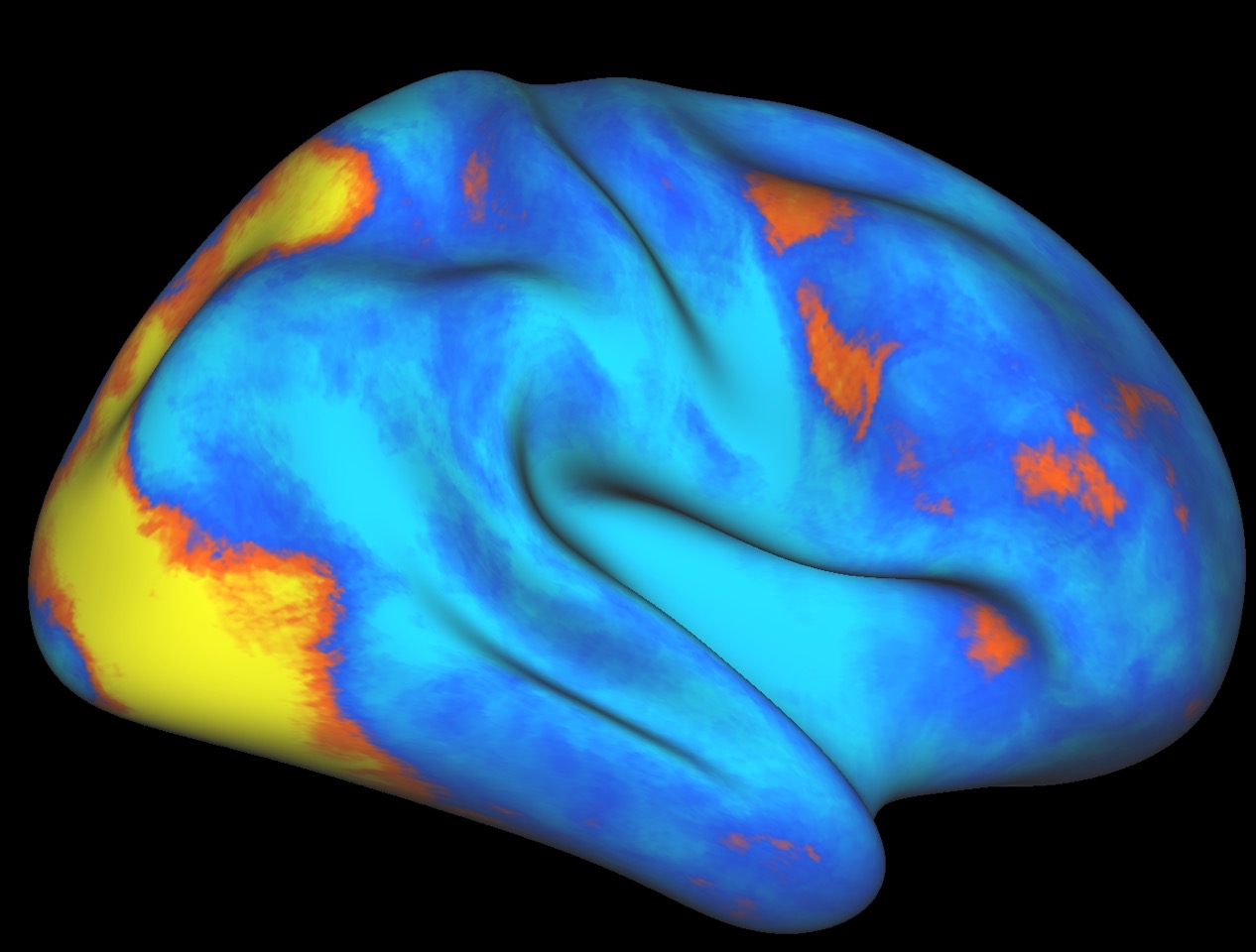 fMRI scan of human brain highlights areas involved in unique attention network