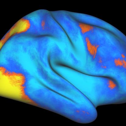 fMRI scan of human brain highlights areas involved in unique attention network